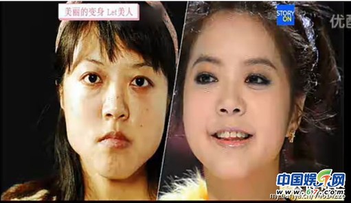 多圖劇透韓國整容節(jié)目《LET 美人》近幾期，最愛小V臉，人瘦就能美