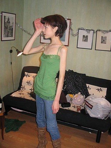 瘦到驚人的厭食癥患者