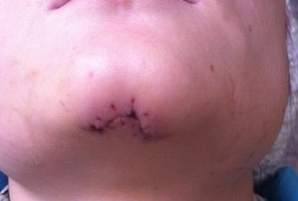 年輕女子被撞毀容 肇事方提醒藥費超限不給報