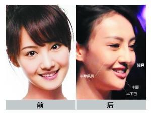 鄭爽被疑整容 醫生鑒定：整了鼻子下巴唇蘋果肌(圖)