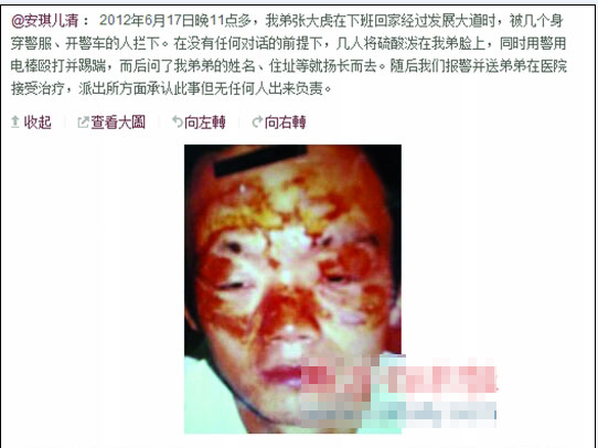 張大虎的姐姐將弟弟面部燒傷一事發上微博，引發網友廣泛關注。